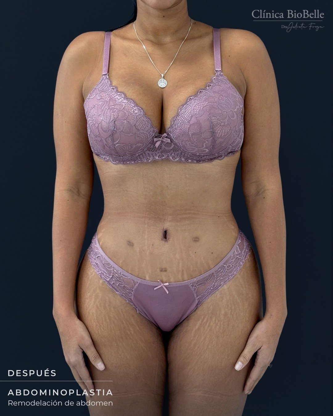 Queremos compartirles este caso tan lindo de Abdominoplastia ✨
Nuestra paciente, después de convertirse en mamá, vivió varios cambios en su peso. Tras una cirugía bariátrica, decidió dar un nuevo paso y mejorar su abdomen mediante una cirugía estética, siempre priorizando su bienestar y seguridad 💖
👀 En el antes y después pueden notar dónde se encuentran las cicatrices de la cirugía bariátrica, parte de su historia y de todo el proceso que ha vivido ✨
Gracias por confiar en nosotros y permitirnos acompañarte en este camino tan importante 💫
📍 La Concepción 141, Oficina 202 – Providencia
📞 +569 6677 12 93
#Abdominoplastia #AntesYDespués #ClínicaBiobelle #CirugíaEstética #ProcesoReal #HistoriasReales