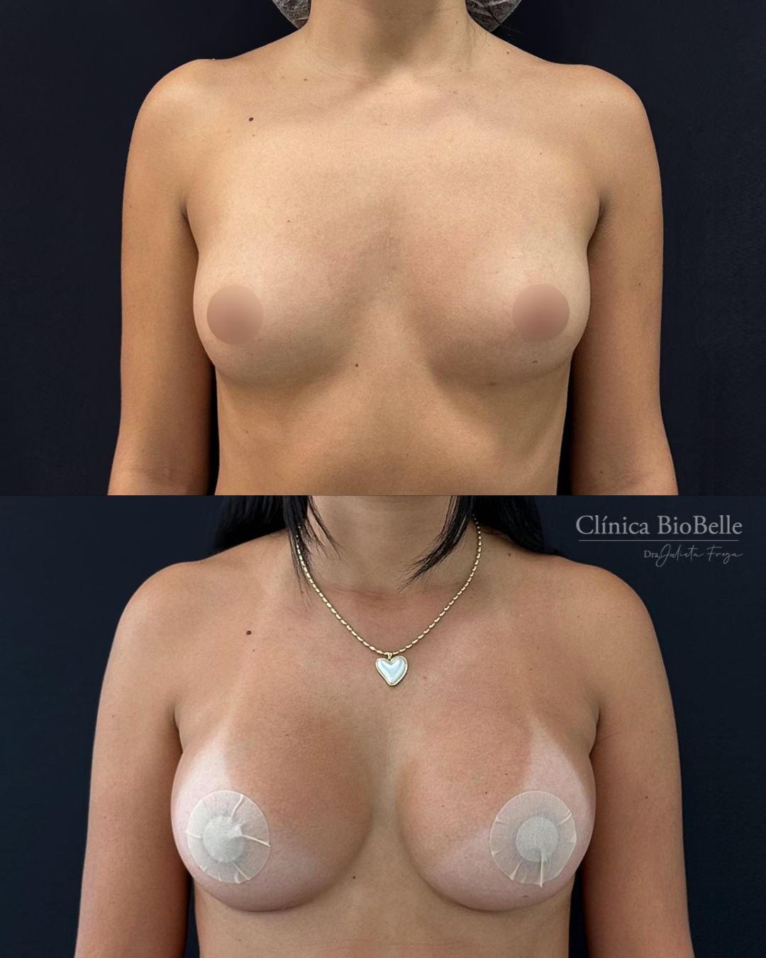 ❤️🔥 Mamoplastia de aumento 350cc
Prótesis Motiva - Dual Plane
📍 La Concepción 141, Oficina 202 – Providencia
📞 +569 6677 12 93