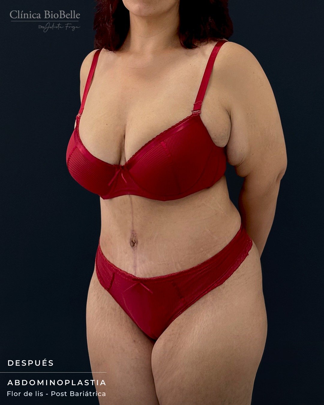 Abdominoplastia en Flor de Lis ✨
Compartimos este caso tan especial de abdominoplastia en Flor de Lis, un procedimiento indicado principalmente en pacientes que han tenido bajas masivas de peso, como después de una cirugía bariátrica.
Debido al exceso de piel en la región abdominal, se realiza un corte horizontal y vertical para lograr un contorno firme y definido. Al inicio, las cicatrices pueden ser más visibles, pero con el tiempo y los cuidados adecuados, se transforman en líneas finas y discretas.
Si has tenido un cambio importante de peso o una cirugía bariátrica y deseas una evaluación médica personalizada, puedes enviarnos tu número para que te contactemos o escribirnos directamente por WhatsApp:
📲 +569 6677 12 93
📍 La Concepción 141, Oficina 202 – Providencia