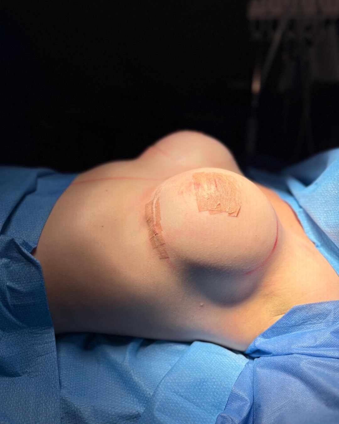 Prótesis mamarias Polytech 380cc ❤️🔥
#aumentomamário #protesismamarias #aumentomamariochile #polytech #breastaugmentation