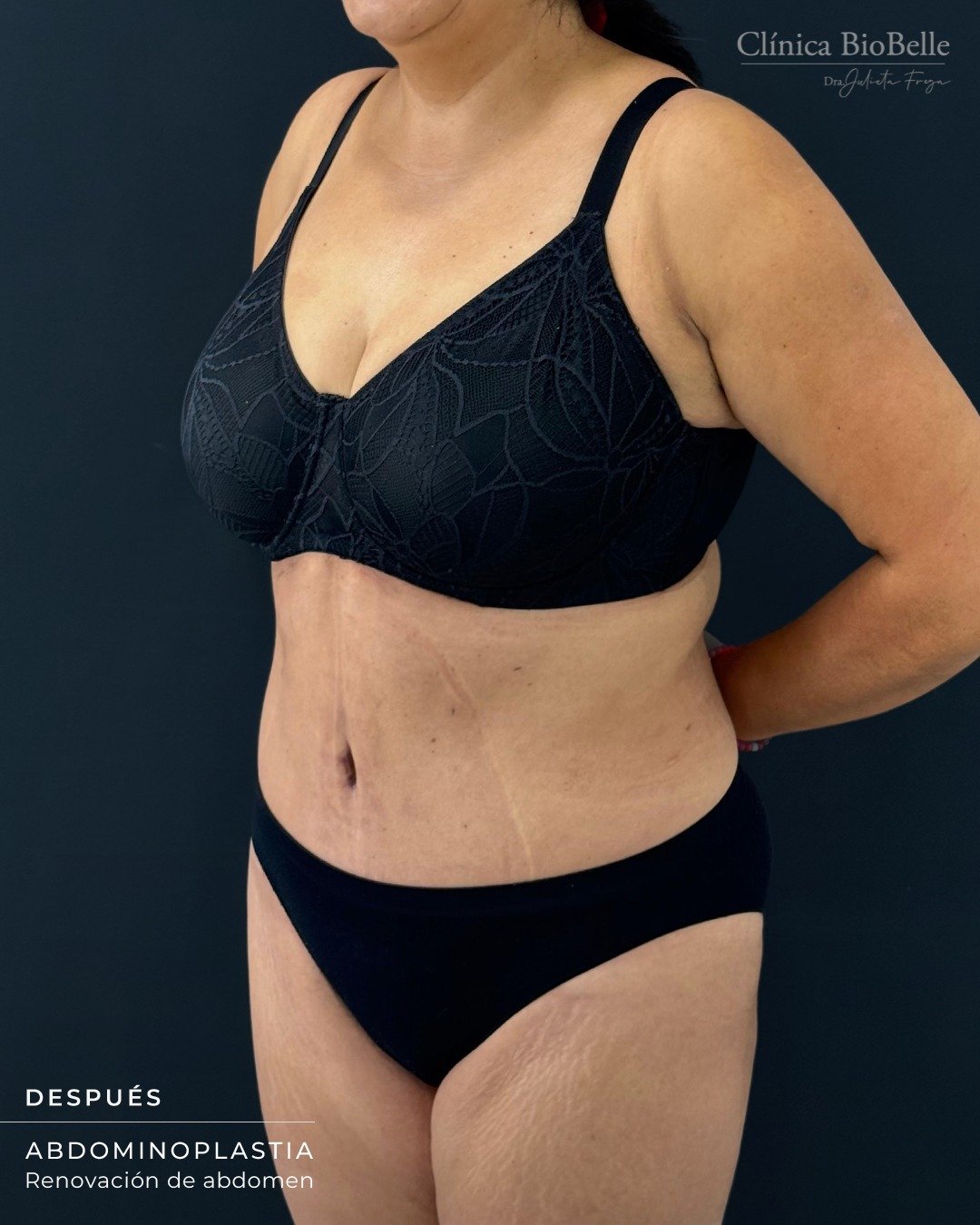 Abdominoplastia | Renovación de abdomen ✨
Les compartimos este caso de abdominoplastia, un procedimiento que permite mejorar el contorno abdominal, retirar el exceso de piel y lograr un abdomen más firme y armónico.
📩 Si deseas asistir a una evaluación médica, puedes enviarnos tu número de contacto para llamarte y coordinar tu cita o comunicarte a nuestro WhatsApp:
📲 +56 9 6677 12 93
📍 Estamos ubicados en:
La Concepción 141, Oficina 202. Providencia