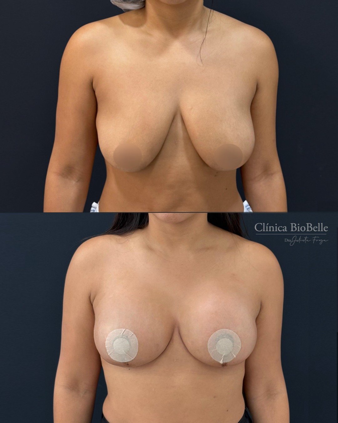 Resultado de mastopexia con implantes 330 cc Dual Plane ✨
En este caso realizamos una mastopexia con implantes para elevar el busto, mejorar su posición y recuperar volumen de forma armónica.
Utilizamos implantes de 330 cc con técnica Dual Plane, logrando una forma más proyectada y natural.
Es importante considerar que se trata de un postoperatorio reciente, por lo que todavía puede observarse inflamación mientras los tejidos continúan acomodándose.
📩 Si quieres evaluar tu caso, escríbenos por DM o a nuestro WhatsApp.