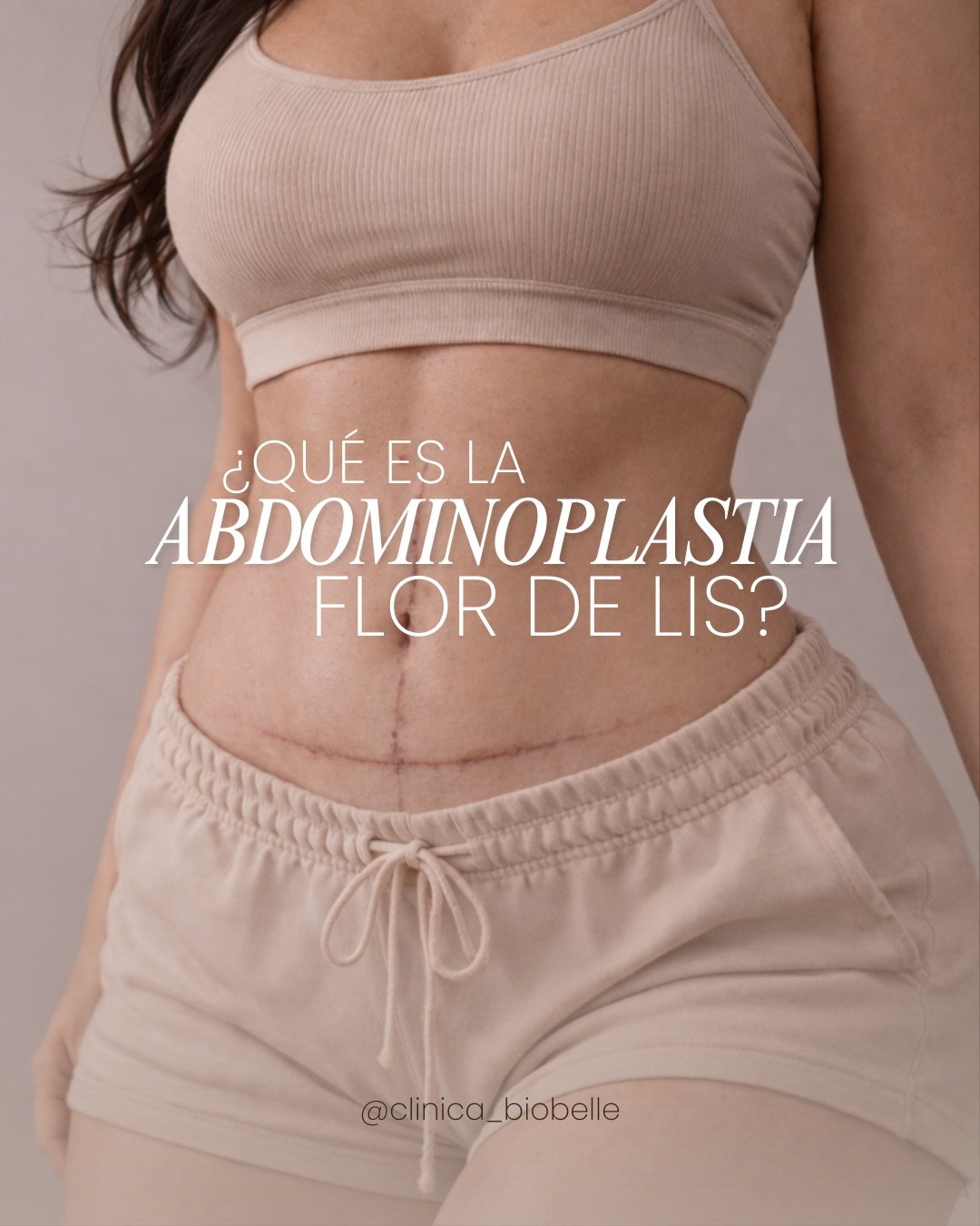 No todas las abdominoplastias son iguales.
La abdominoplastia tradicional y la abdominoplastia en Flor de Lis tienen indicaciones diferentes según la anatomía, el exceso de piel y las necesidades de cada paciente. 
Una valoración médica es clave para elegir la mejor opción y lograr un mejor contorno abdominal. ✨

#Abdominoplastia #CirugiaPlastica #ContornoAbdominal #FlorDeLis #CirujanoPlastico