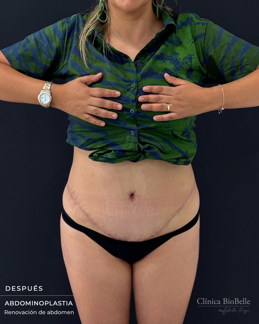 Les mostramos este caso de abdominoplastia, en una paciente que presentaba cambios a nivel abdominal, con exceso de piel y flacidez.

El abordaje quirúrgico se planificó de forma individual, buscando mejorar el contorno abdominal y lograr un resultado armónico, acorde a su anatomía.

La indicación de este tipo de procedimiento siempre debe definirse en una valoración médica, considerando las características y objetivos de cada paciente.

#Abdominoplastia #CirugiaEstetica #ContornoAbdominal #AntesYDespues #ClinicaBiobelle #SantiagoDeChile